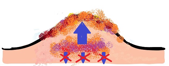 脱ステロイドのリバウンド